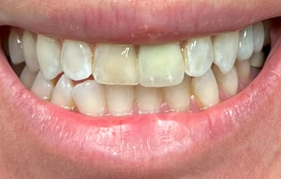 Before cosmetic dentistry showing worn and discolored teeth.