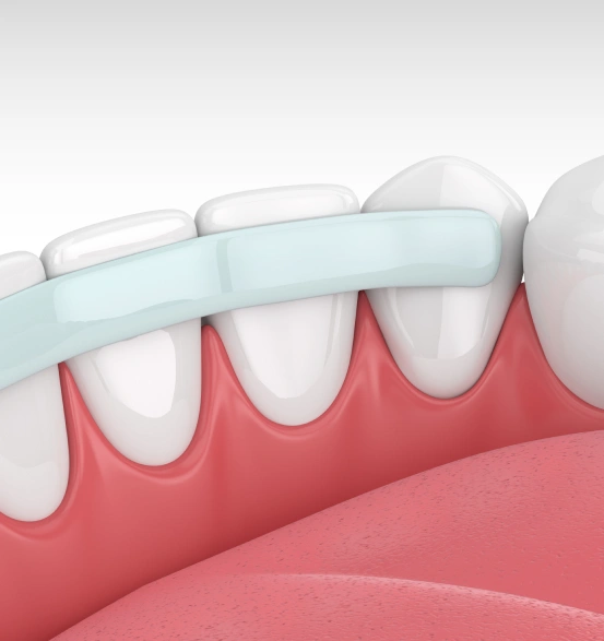Composite dental bonding repairing a chipped front tooth for a natural-looking smile.