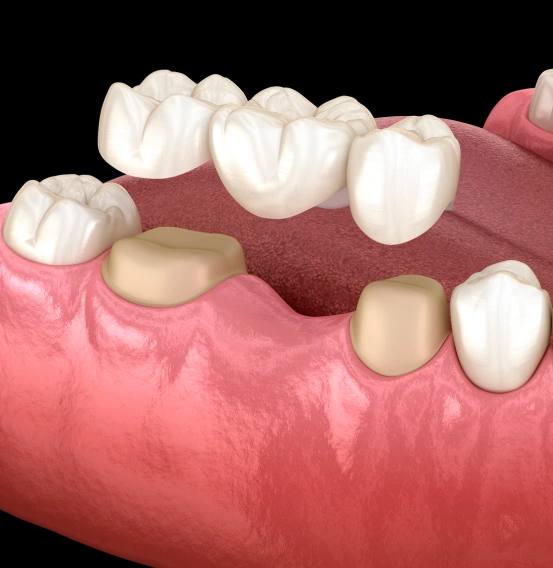 Dental bridge replacing a missing tooth to restore a complete smile.