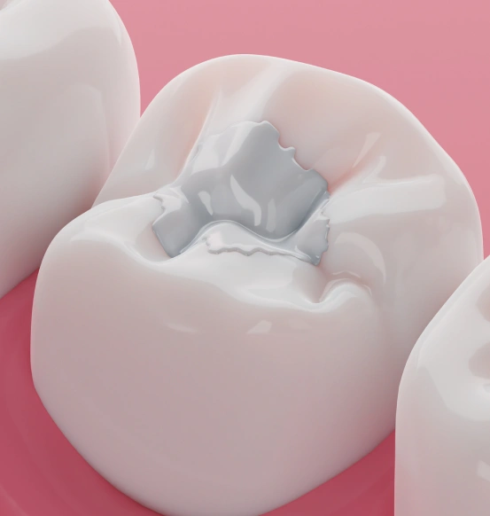 Tooth colored dental filling restoring a cavity in a damaged tooth.
