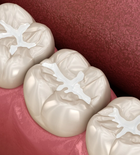 Dental sealants applied to molars to protect teeth from cavities and decay.
