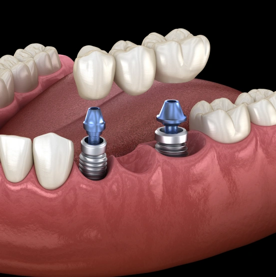 Illustration of an implant-supported dental bridge.