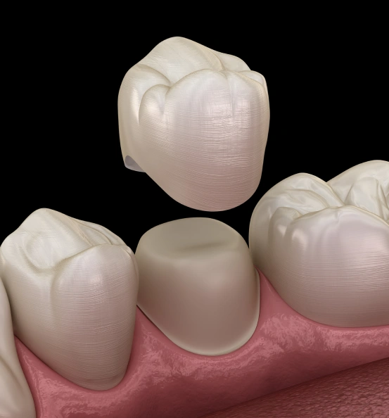 Same-day dental crown restoring a damaged tooth with a natural-looking ceramic crown.