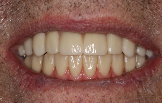 After treatment at Sumner Dental group