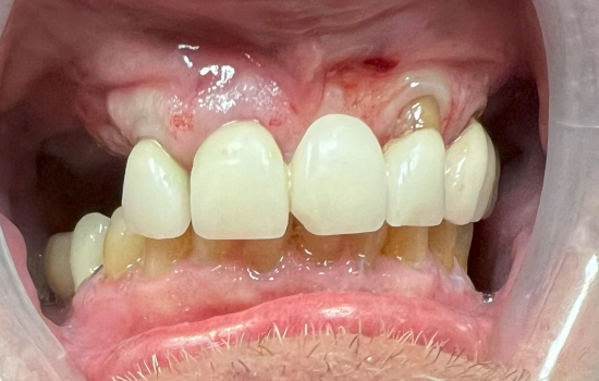 Before treatment at Sumner Dental group