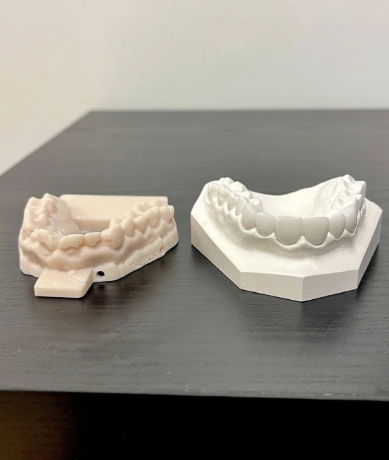 Find Out If Veneers Are Right for You