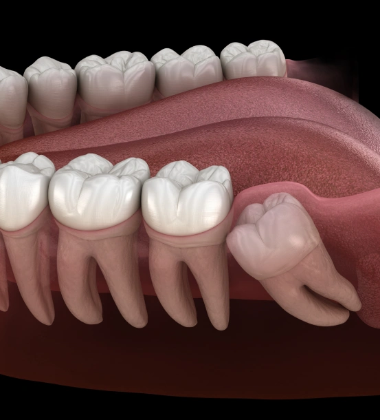 Expert Care for Impacted and Problematic Wisdom Teeth